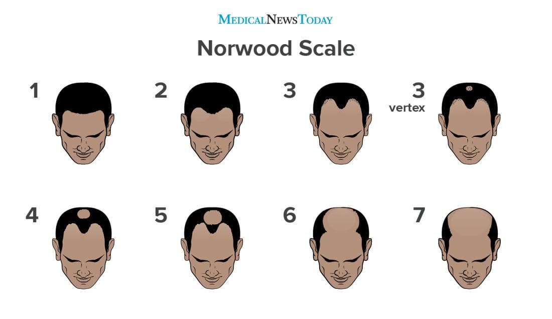 Norwood Scale
